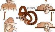 耳石症手法复位视频,耳石症手法复位操作步骤详解